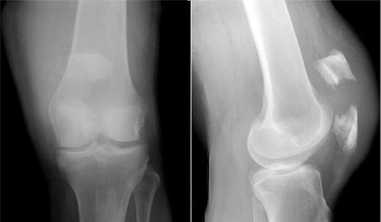 osteoartrita deformatoare a articulației genunchiului stâng